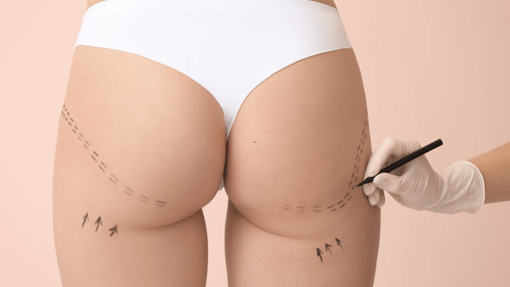 Liposuction Results in Lusby and Huntingtown Maryland